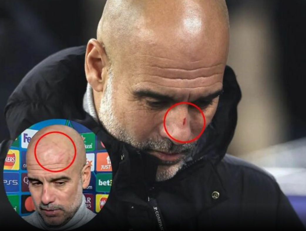 Guardiola shfaqet i gjakosur pas barazimit me Feyenoordin: Doja t’i bëja keq vetës