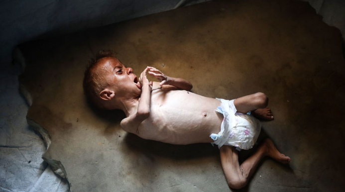 OKB: Kequshqyerja tek fëmijët në Gaza arrin nivelin më të lartë, gati 12,000 raste në korrik