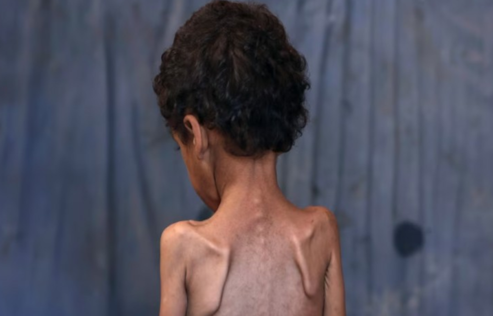 Save the Children: Fëmijët e uritur në Gazë nuk kanë forcë as të qajnë