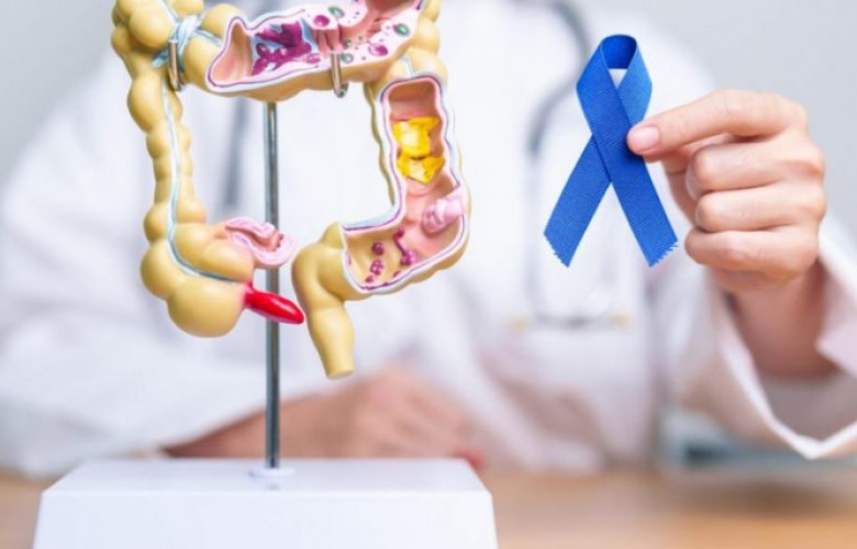 Kanceri kolorektal po prek gjithnjë e më shumë të rinjtë