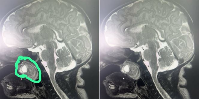 Realizohet me sukses një ndërhyrje e rrallë kirurgjikale, tumori largohet nga foshna e posalindur